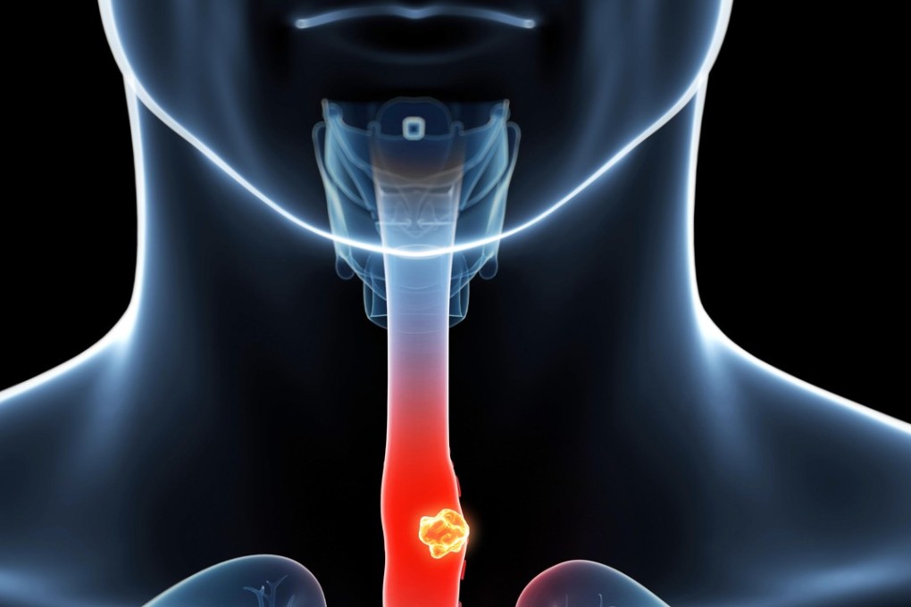 Gum disease increases the likelihood of cancers including oesophagal cancer in women, a study shows. Image: Alamy