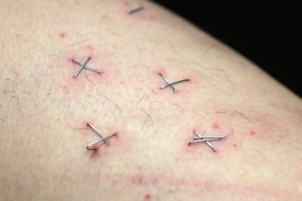 Howard Lam shows his wounds at a press conference. Photo: Felix Wong