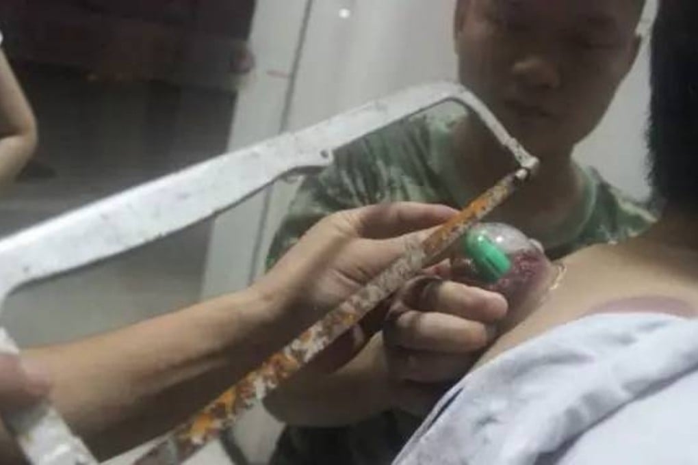 Firefighters used a hacksaw to make a small crack in the glass cup so that they could remove it. Photo: Handout