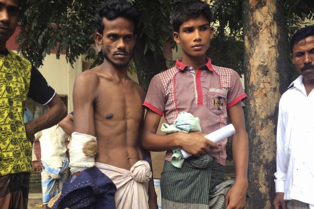 Rohingya men show their bullet wounds outside Sadar hospital, in Cox’s Bazar, Bangladesh. Photo: AP