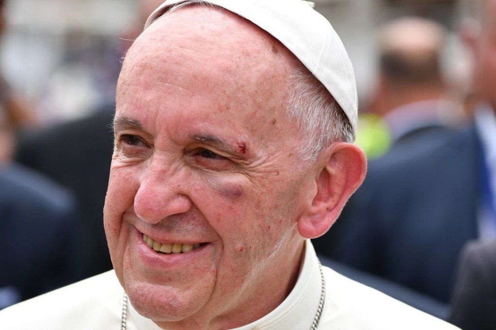 Pope Francis smiles with a bruise on his face after he knocked his head on the Popemobile, in Cartagena, Colombia, on Sunday, September 10, 2017. Vatican spokesman Greg Burke said the pontiff “is fine” but has “a bruise on his cheekbone and eyebrow. Photo: AP