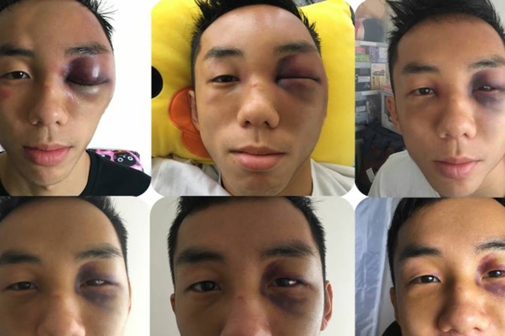 Rex Tso shows the progression of his left eye healing. Photo: Rex Tso/Facebook