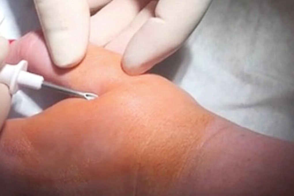 Volunteers in Australia have had microchips inserted for three months, designed to unlock doors and carry out other tasks. Microchips are encased in an inert glass capsule and typically inserted between the thumb and the forefinger. Photo: Kayla Heffernan/Pause Fest
