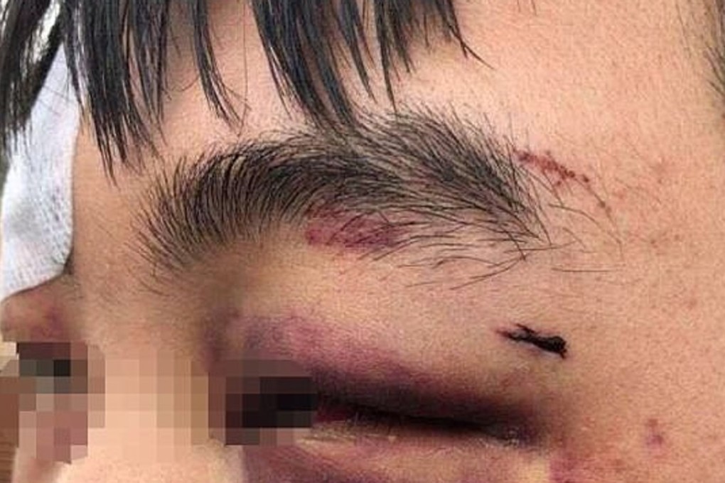 Pictures of the injuries suffered by three Chinese high school students in Canberra, Australia, have surfaced online. Photo: Internet