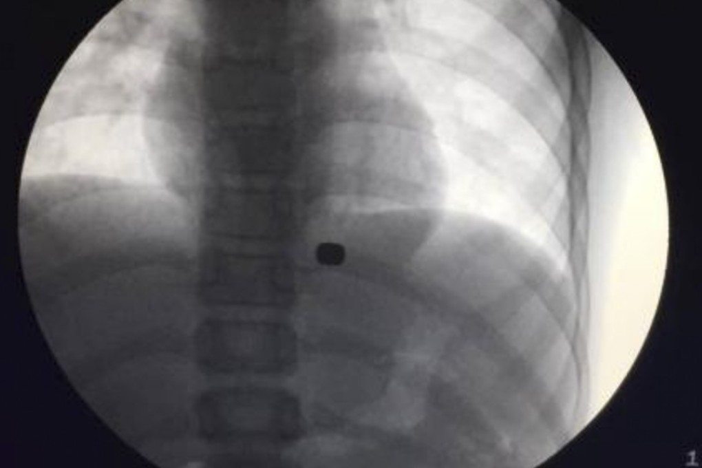 An X-ray shows how the magnets had become stuck in the boy’s stomach. Photo: China News