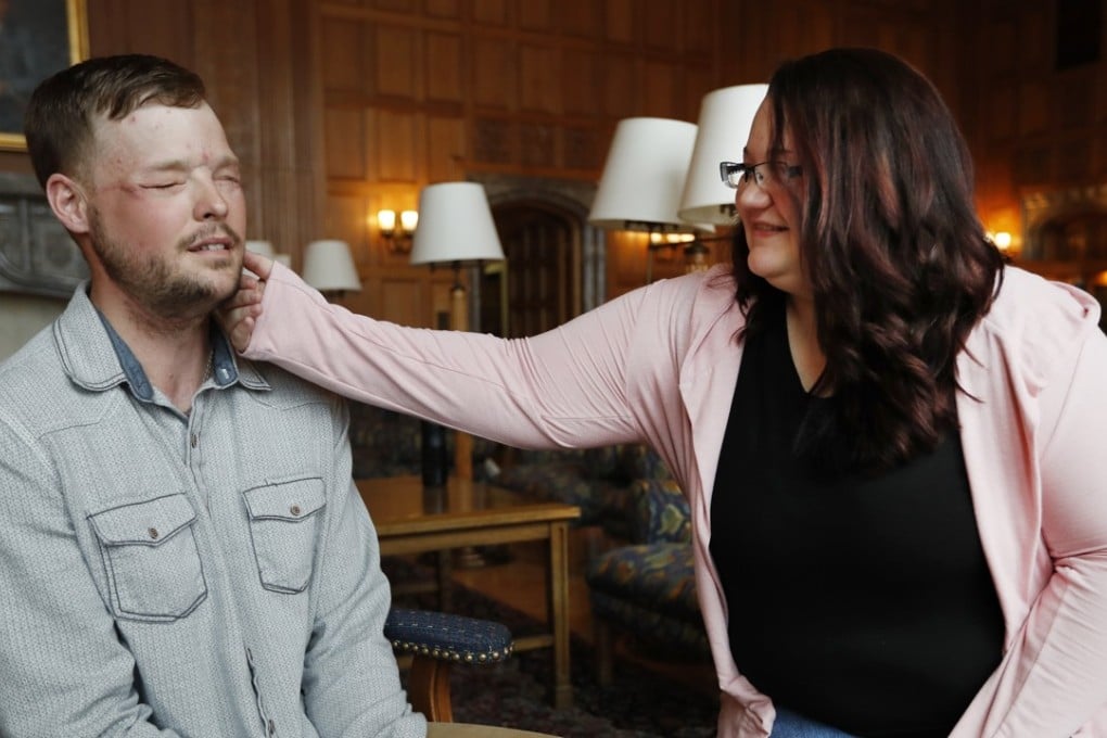 Lilly Ross, right, feels the beard of face transplant recipient Andy Sandness during their meeting. Photo: AP