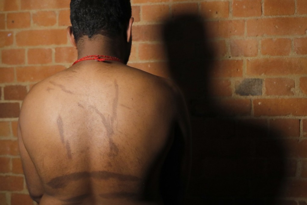 A Sri Lankan man known as Witness #249 shows brand marks on his back. While he was in detention, he said his captors used hot iron rods to make the marks symbolising tiger stripes for the Tamil Tigers rebel group. The Sri Lankan government has vowed to crack down on torture. Photo: AP