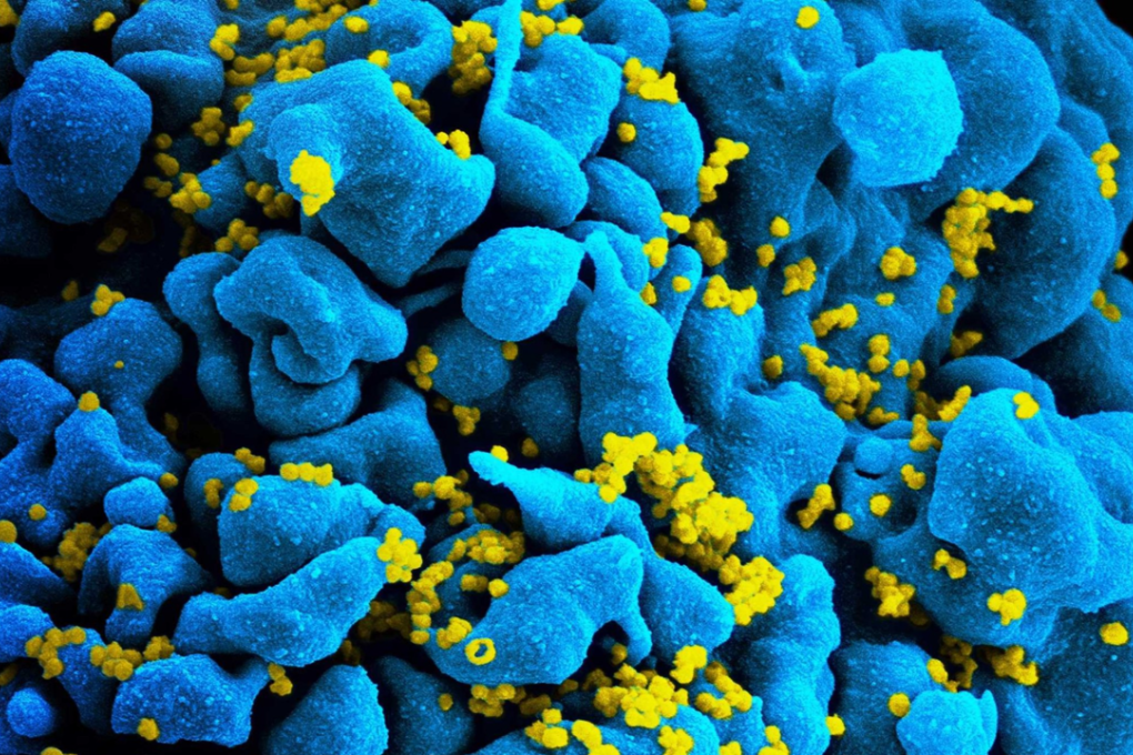 Scanning electromicrograph of an HIV-infected T cell. Photo: NIAID
