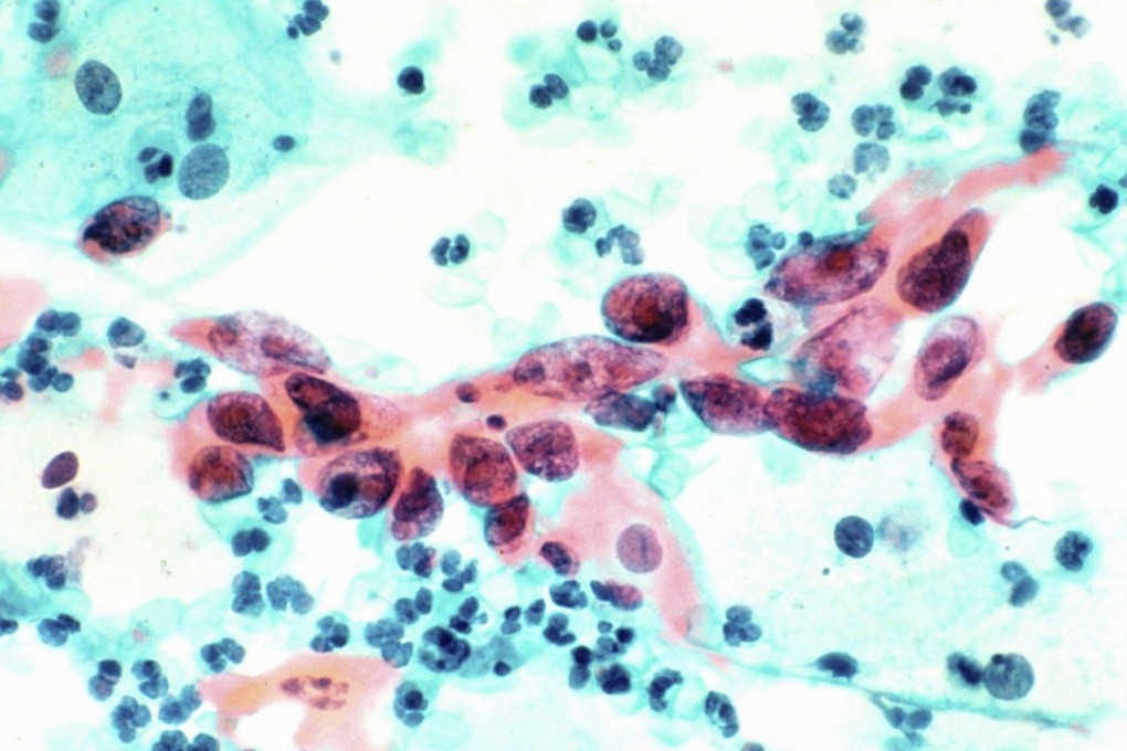 Cervical cancer was the seventh most common cancer for Hong Kong women in 2015. Photo: Alamy