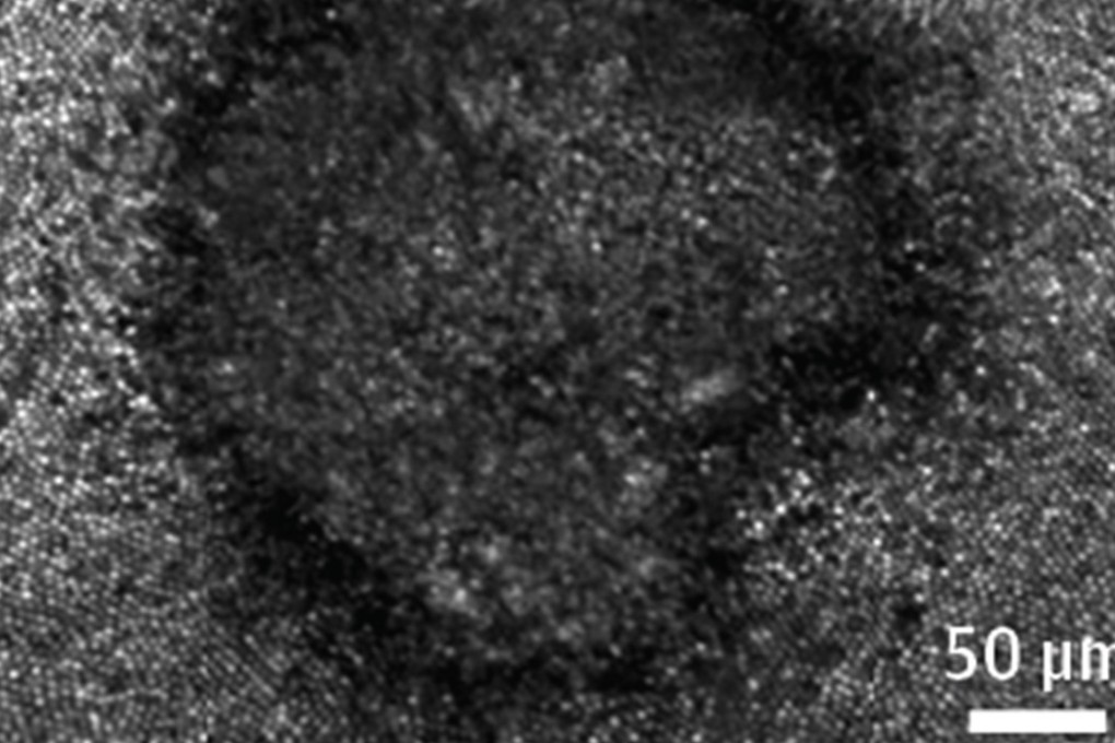 An eclipse-shaped image was burned onto the retina of a New York woman in her 20s who stared at the August 21 phenomenon without good eye protection. A retina scan revealed the dark grey circle in the shape of the sun with the moon's silhouette crossing its edge at lower right. Photo: JAMA