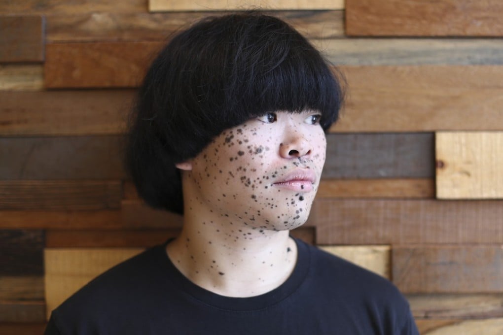 William Chan was diagnosed with a rare and lethal form of skin cancer at birth, but 30 years on he is still defying the odds. Photo: Nora Tam