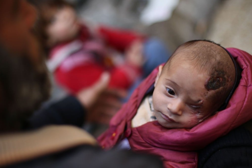 A picture taken on December 4 shows Syrian baby Karim Abdallah who lost his left eye and his mother in government shelling on the town of Hammuriya. Photo: Agence France-Presse