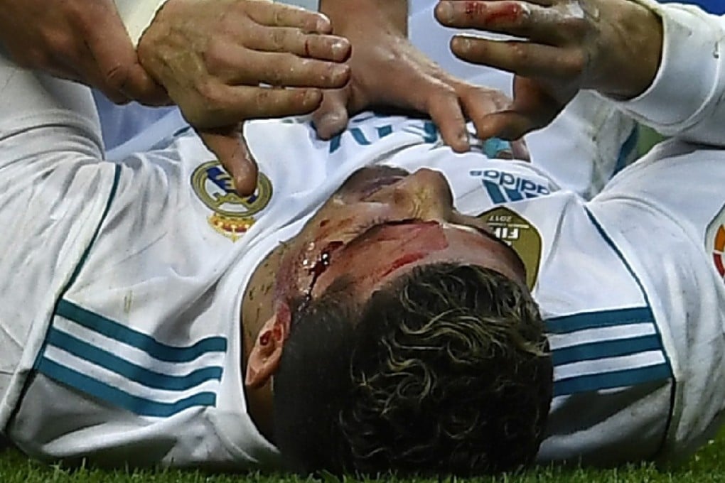Cristiano Ronaldo lies on the pitch after sustaining a facial injury against Deportivo. Photo: AFP