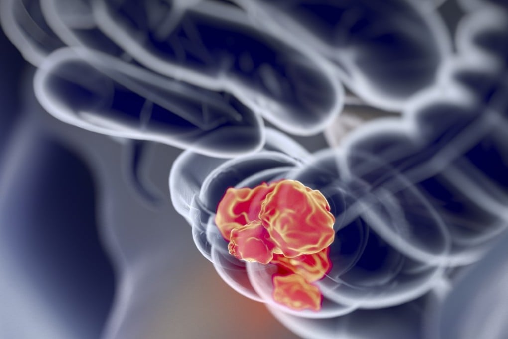 About 2,089 Hongkongers died from colorectal cancer in 2016, making up about one in every seven cancer deaths.