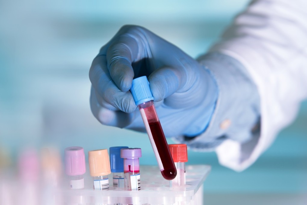 The Alzheimer’s disease test measures for high levels of the amyloid beta protein in the blood. Photo: Shutterstock