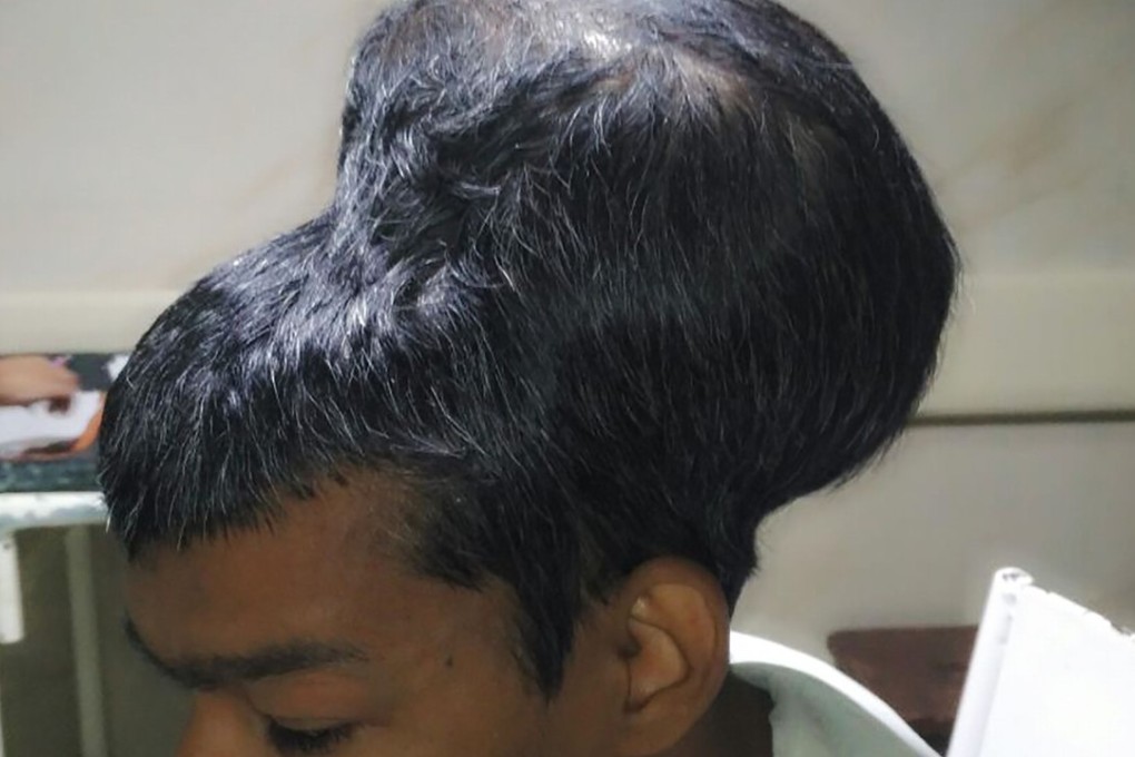 A handout picture released by the Department of Neurosurgery at Topiwala National Medical College, in Nair Hospital, Mumbai, shows 31-year-old Santlal Pal before undergoing surgery to remove a massive brain tumour. Photo: Agence France-Presse