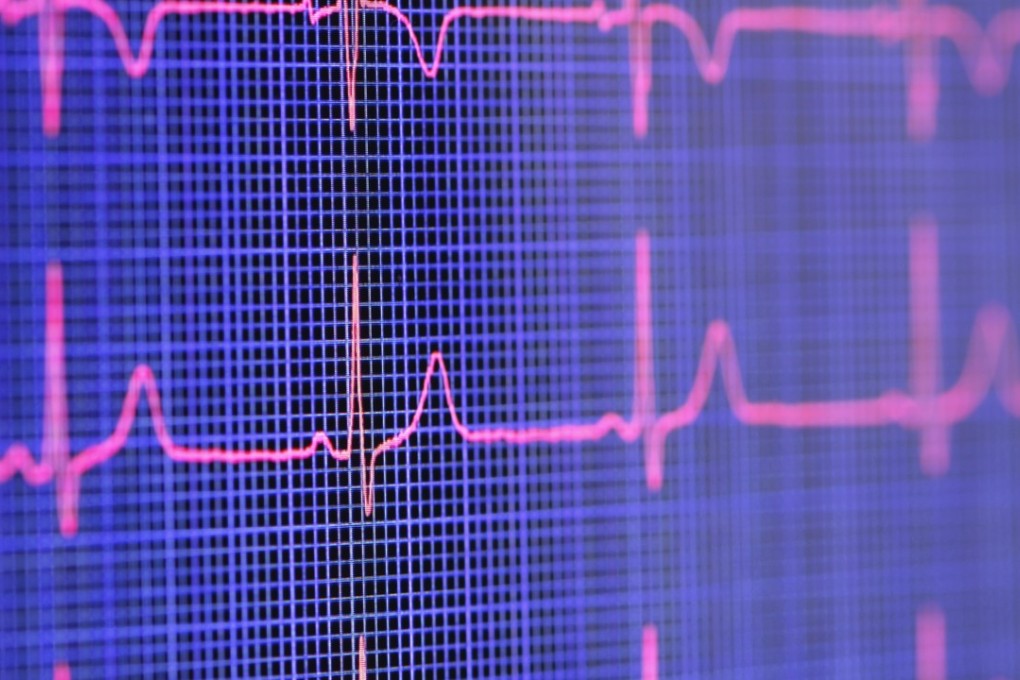With the next medical facility 150 kilometres away and no one else around to help, the man hooked himself up to an electrocardiogram (EKG), which showed a complete heart block. File photo: Corbis