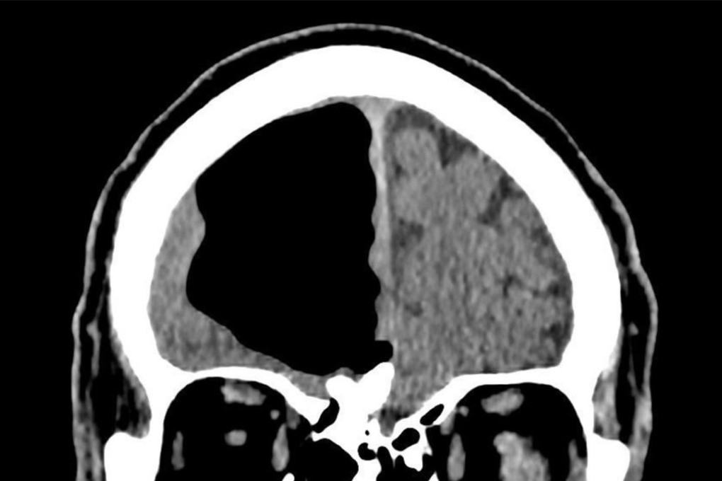 Doctors were shocked at the size of the air bubble that had taken up a large space in the man’s skull, pushing aside part of his brain. Photo: BMJ Case Reports