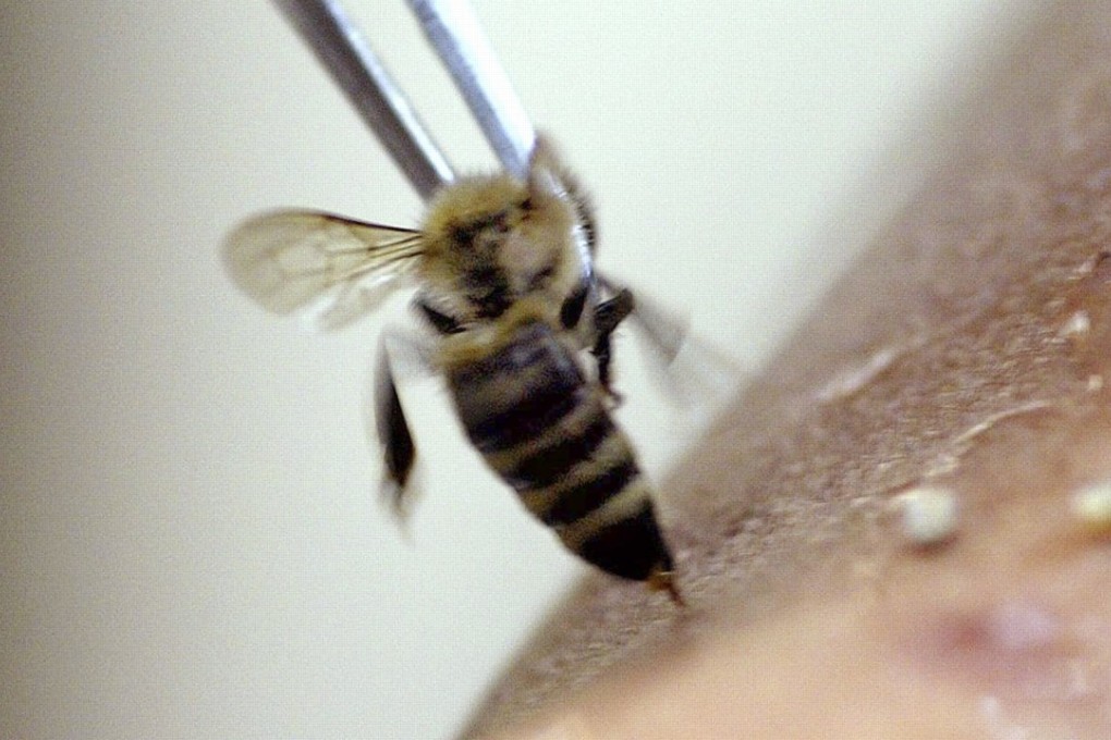 A live bee is applied to a patient and induced to sting during a bee-sting acupuncture session in this file photo. Photo: Agence France-Presse