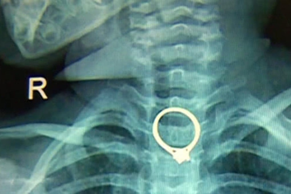 X-ray images show how the ring became lodged in the girl’s oesophagus. Photo: qq