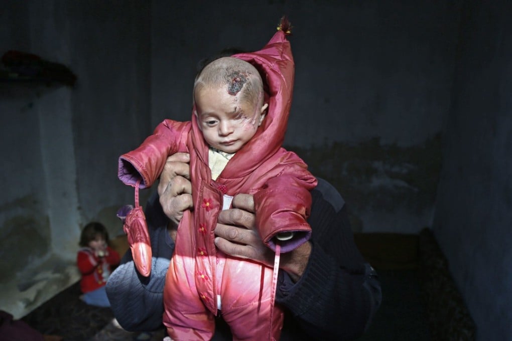 Syrian baby Karim Abdallah who lost his left eye and his mother in government shelling on the town of Hammouria. File photo: AFP