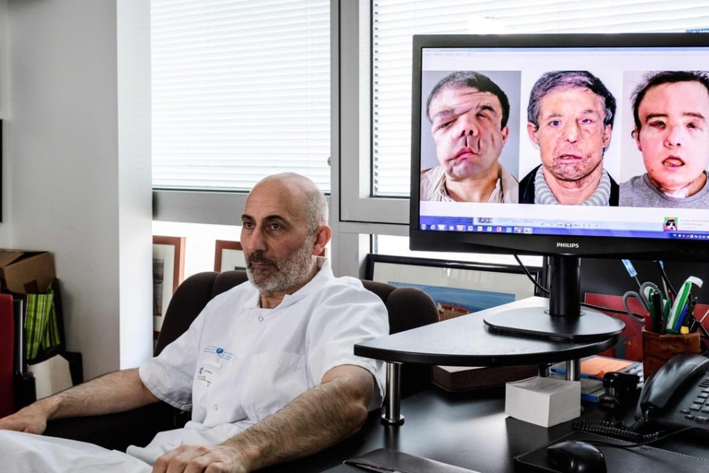 French transplant surgeon Laurent Lantieri poses next to a screen showing the three faces of his patient Jerome Hamon – at left is his original face that was disfigured by a genetic mutation, in the centre is the transplanted face that belonged to a 60-year-old man, and at right is Hamon’s new face that belonged to a 22 year old. Photo: Agence France-Presse