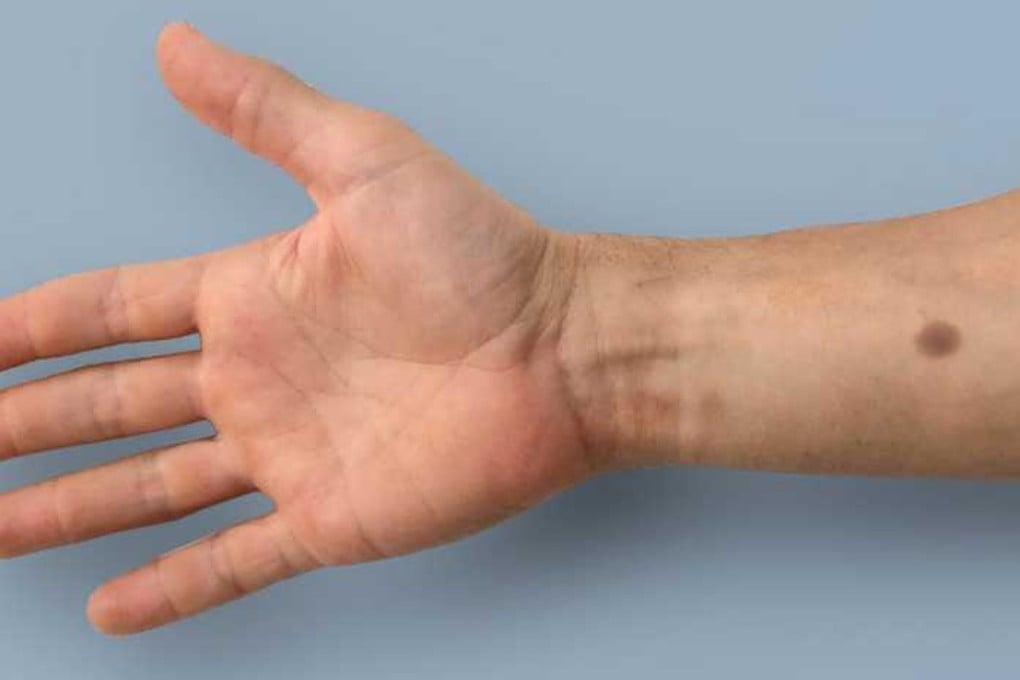 An experimental skin implant darkens like a mole when it detects subtle changes in the body that may be early warning signs of cancer. Photo: ETH Zurich