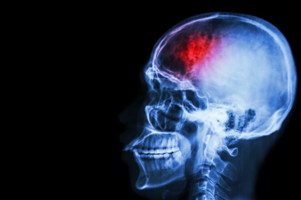 There are 7,000 cases of acute ischemic strokes every year in Hong Kong. Photo: Shutterstock