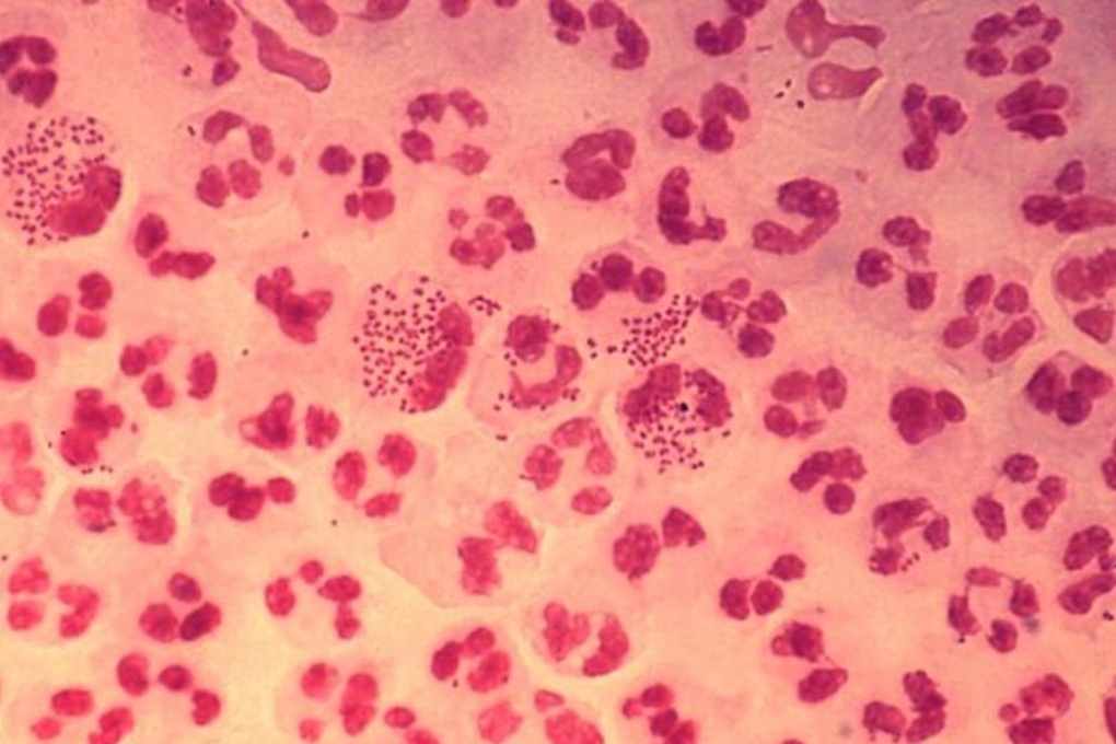 'Super gonorrhea' is spreading. Photo: CDC/Joe Millar