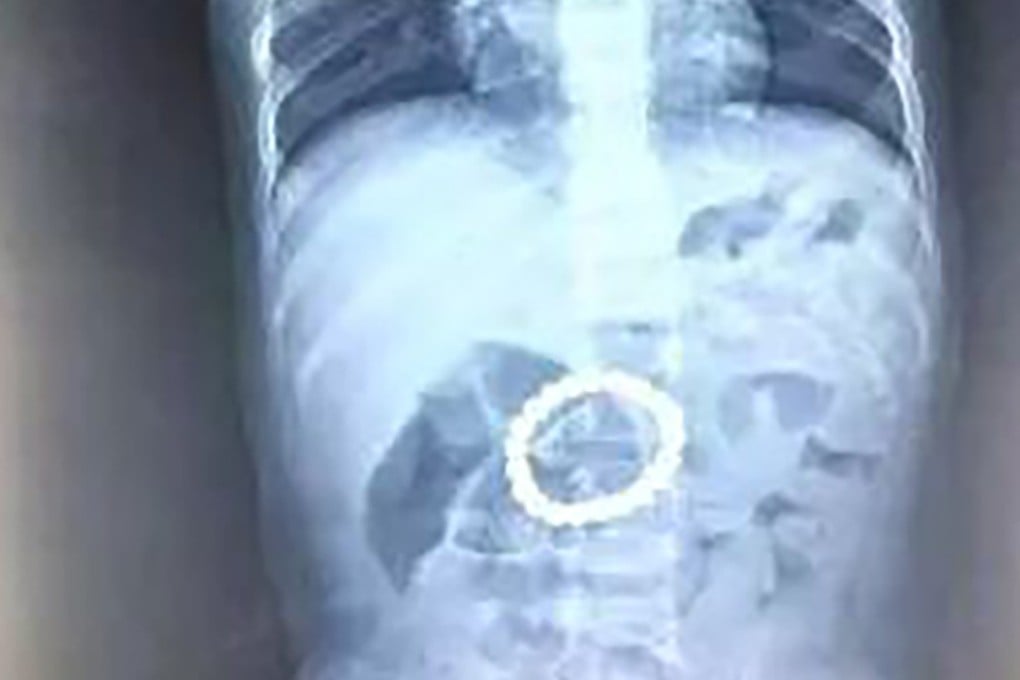 Surgeons at Beijing Children’s Hospital removed a ring of 21 magnetic balls from a toddler’s stomach. Photo: Weibo