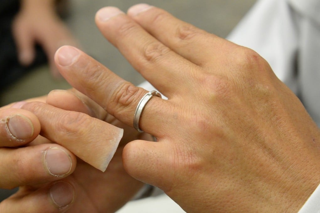A former yakuza with a silicone-made finger. Yakuza who upset their boss can be required to chop off their own digits – if they’re lucky. Photo: AFP