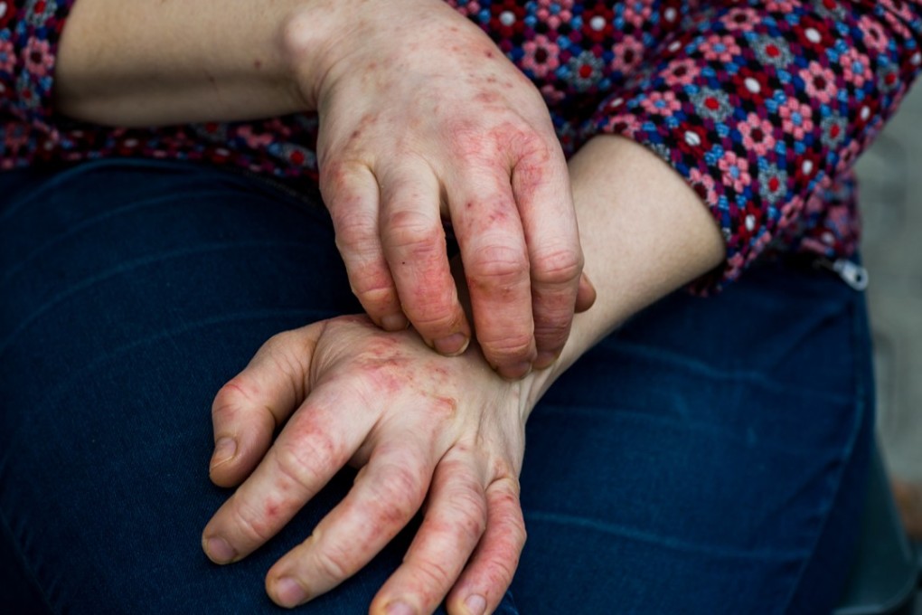 Eczema is an incurable skin condition and the cause of it remains unknown. Photo: Shutterstock