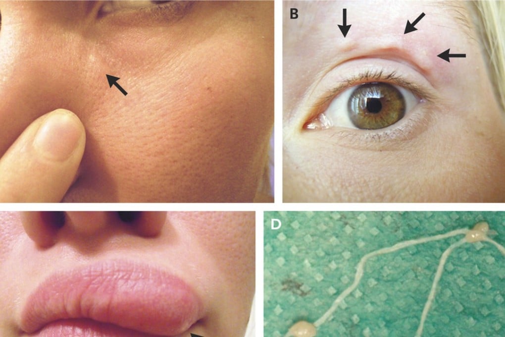A parasitic worm, Dirofilaria repens, was living in a 32-year-old Russian woman's face. Photo: The New England Journal of Medicine