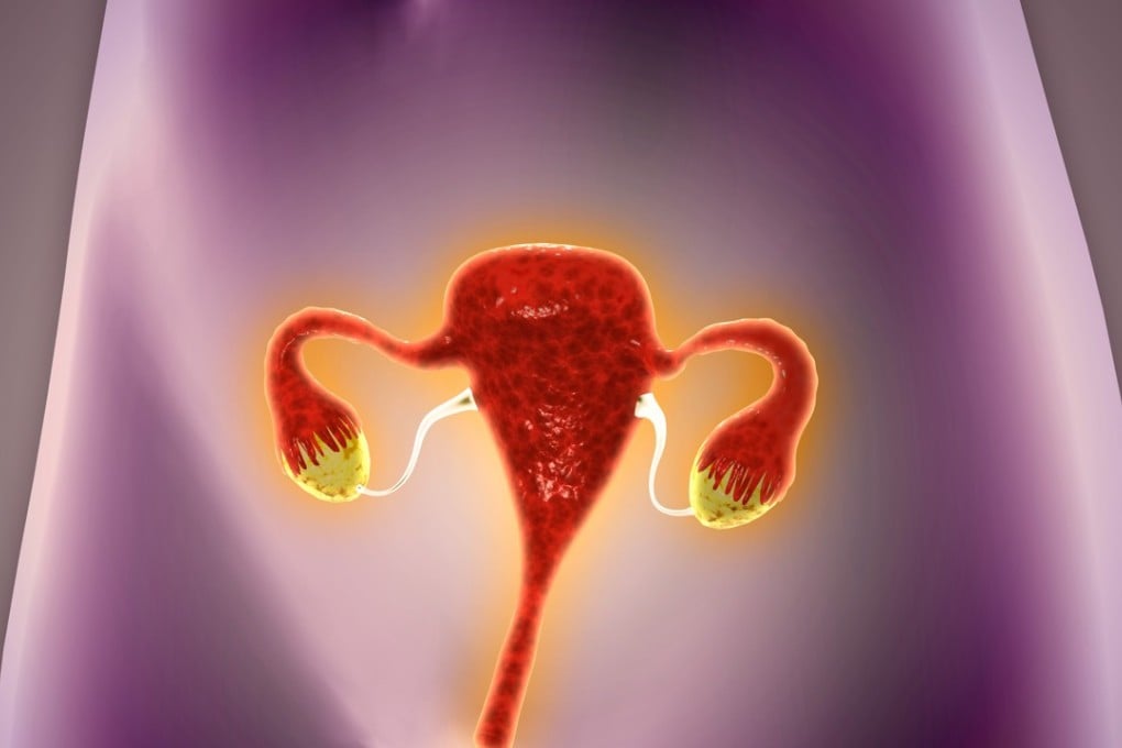 When ovarian tissue is removed from a woman during treatment for cancers like leukaemia or ovarian cancer, there is a risk of the cancer restarting if the tissue is re-implanted. An artificial ovary could instead support a patients’ eggs outside the body during harsh cancer treatments. Graphic: Supplied
