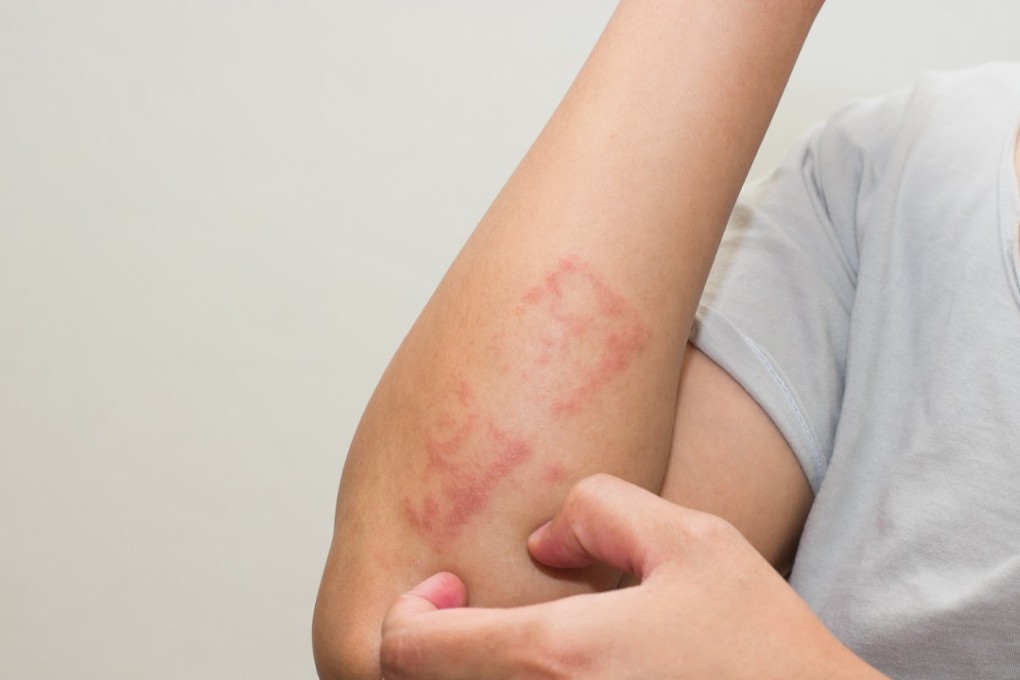 Dermatology, which could help those who suffer from chronic skin conditions like eczema, has not received sufficient attention from Hong Kong universities and medical schools. Photo: Shutterstock