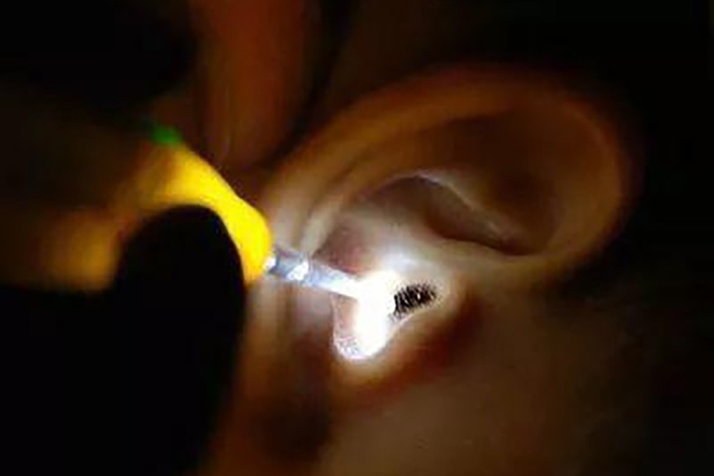 A doctor in Dongguan says he sees one or two cases a month of cockroaches crawling into ears. Source: Sina