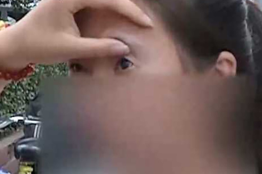Xiaobai, 18, had cosmetic surgery a year ago, but it left her with severe pain and unable to fully use one of her eyelids. Photo: Kankanews
