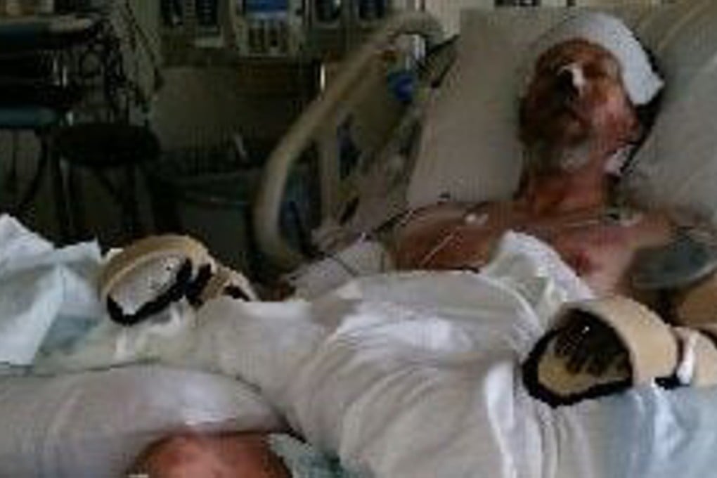Greg Manteufel lies in a hospital bed after the amputation of both his legs. Both his hands were later removed. Photo: Dawn Manteufel
