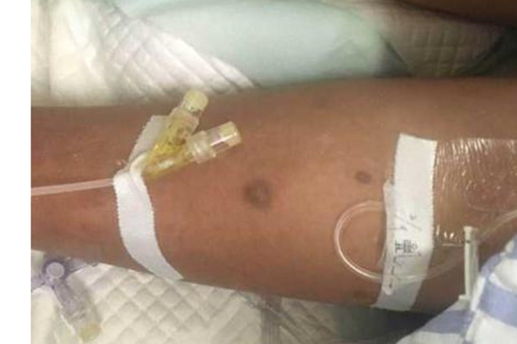 Some of the men’s stings after their ill-fated trip to find wasp larvae. Photo: Weibo