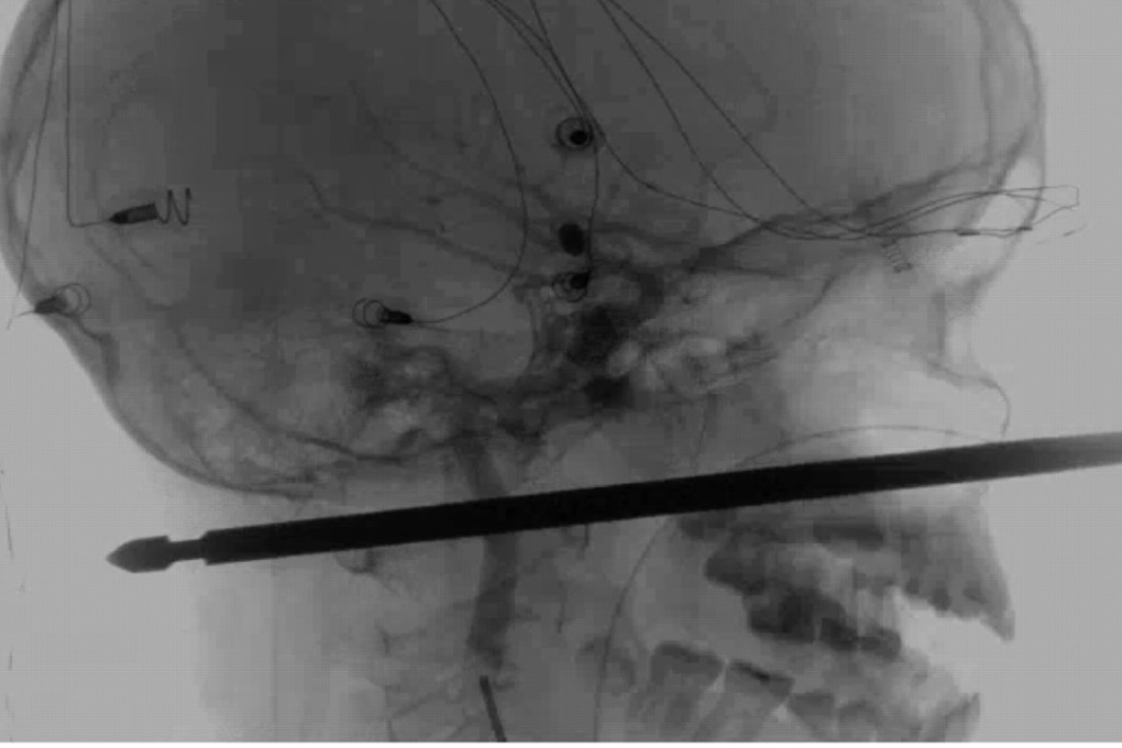 This X-ray provided by the Medical News Network shows a meat skewer impaled in the skull of Xavier Cunningham after an accident at his home on Saturday in Harrisonville, Missouri. Photo: AP