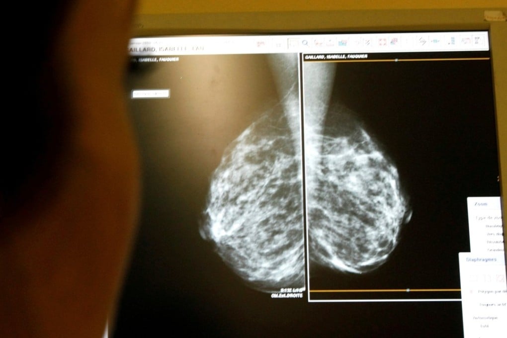 The study found that only one in seven breast cancer patients in the city had a family history of the disease. Photo: Reuters