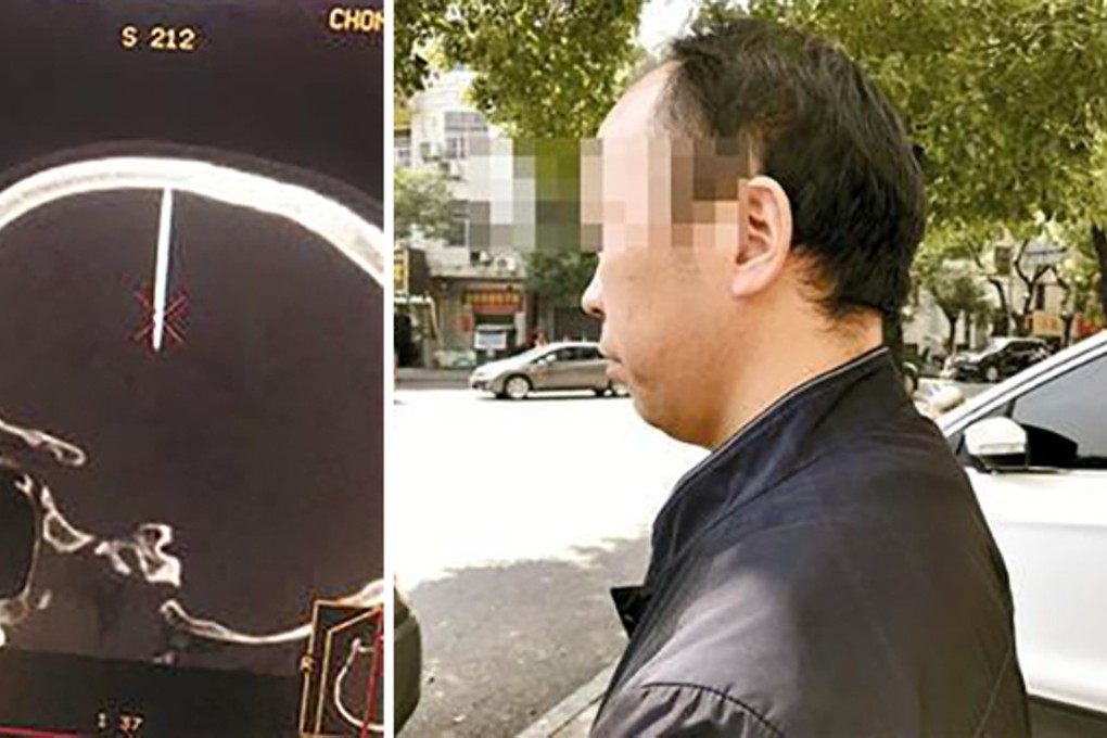 Doctors found the 48mm nail in the man’s skull after he complained of a headache. Photo: Sina