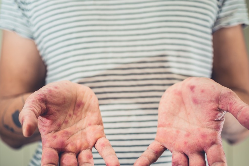 A young man afflicted with hand, foot and mouth disease. Photo: Shutterstock