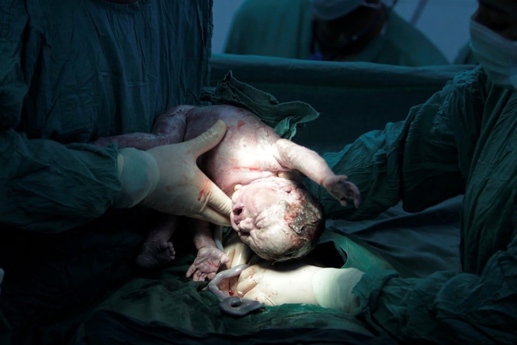 A baby is delivered by caesarean section. The procedure has nearly doubled in two decades worldwide. Photo: Reuters