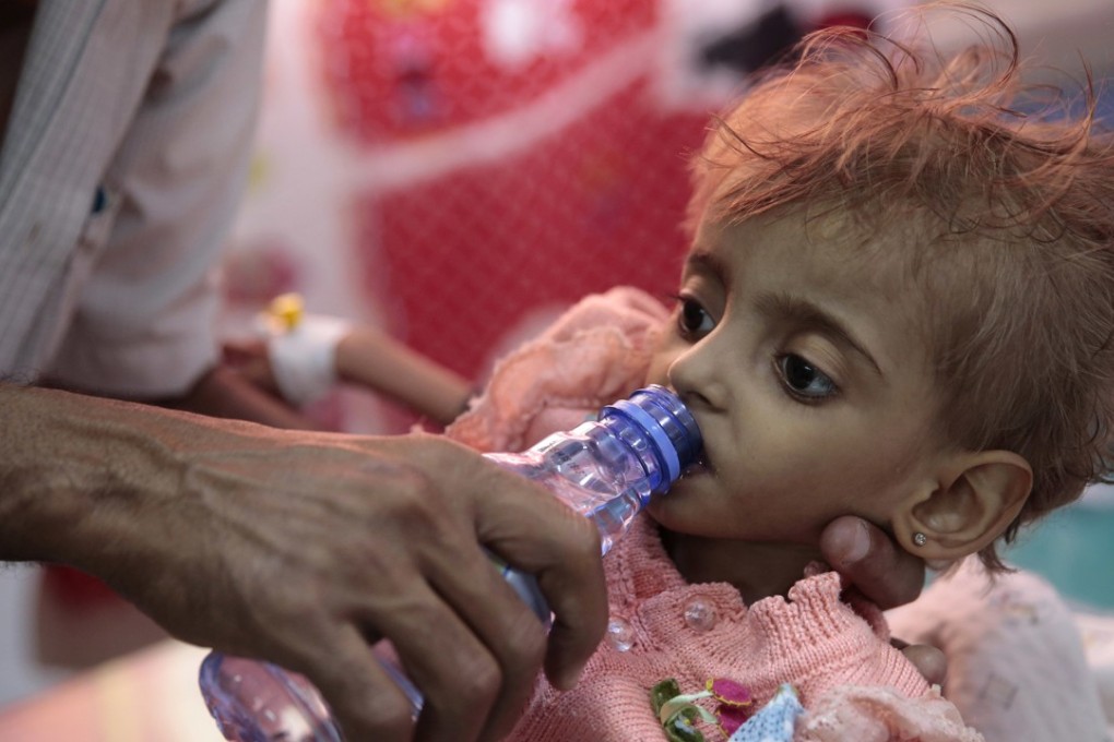 A father gives water to his malnourished daughter at a feeding centre in a hospital in Hodeida, Yemen. Photo: AP