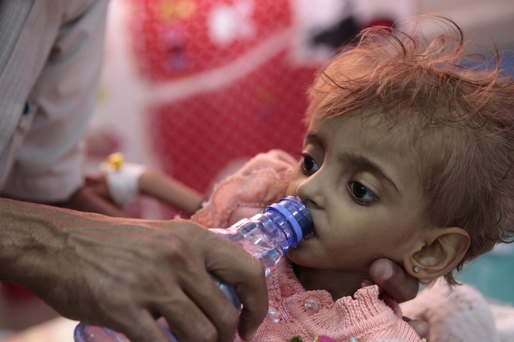 A father gives water to his malnourished daughter at a feeding centre in a hospital in Hodeida, Yemen. Photo: AP