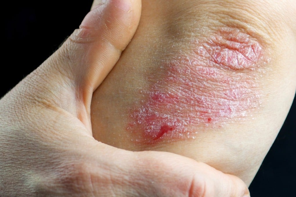 Treatment can only keep psoriasis under control, not cure it. Photo: Shutterstock