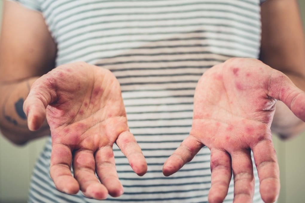 HFMD is clinically characterised by rashes or lesions occurring on the palms, soles and other parts of the body, such as the buttocks and thighs. Photo: Shutterstock