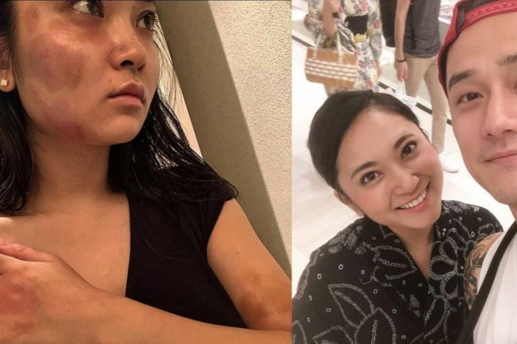 Haruka Nakaura shows the bruises on her face, arms and body (left) and earlier, with Jiang Jinfu. Photo: Shanghaiist
