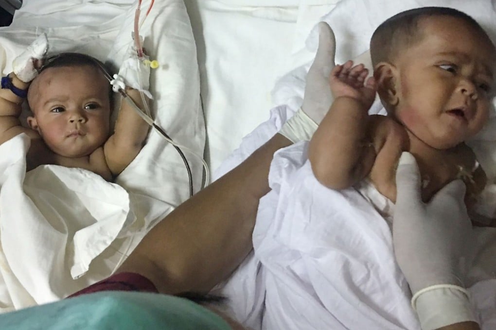 Bangladeshi twins Tofa and Tahura after surgery. Photo: AFP